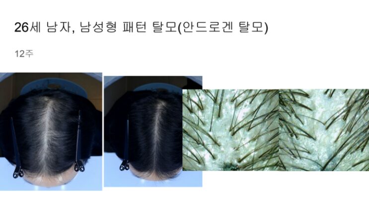 CD34+ PRP 혈액줄기세포 두피 시술