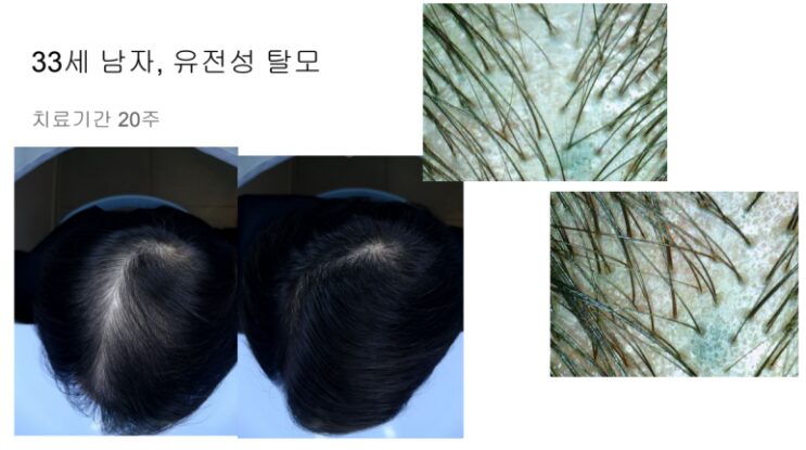 SVF 지방줄기세포 + 미세지방이식