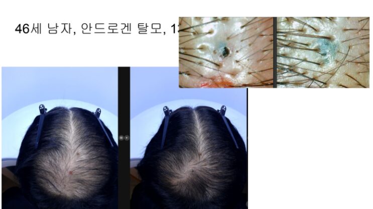 줄기세포 치료 전후 두피 사진 — 모낭 밀도 회복 과정