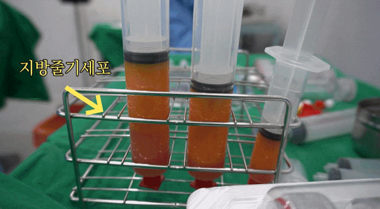 시험관 거치대에 담긴 노란빛의 지방줄기세포 추출물