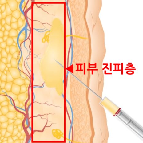 피부 단면도에서 콜라겐·섬유아세포가 모인 진피층 위치를 빨간 박스로 강조한 일러스트