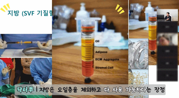 환자의 지방에서 SVF를 분리·농축하는 생물 공정을 나타내는 이미지