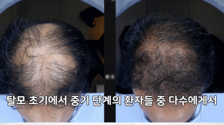 탈모 초기 단계와 중기 단계의 정수리 모발 밀도를 비교한 사진