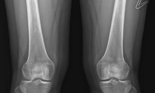 양쪽 무릎 관절 간격을 확인할 수 있는 정면 X-ray 영상