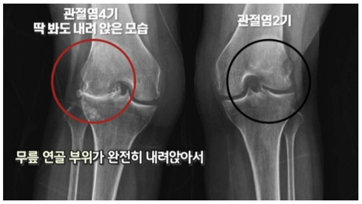무릎 관절염 4기와 2기의 X-ray 비교 영상, 관절 간격이 좁아진 정도 차이