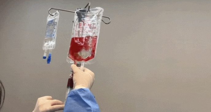 A procedure bag holding an autologous cell concentrate after centrifugation
