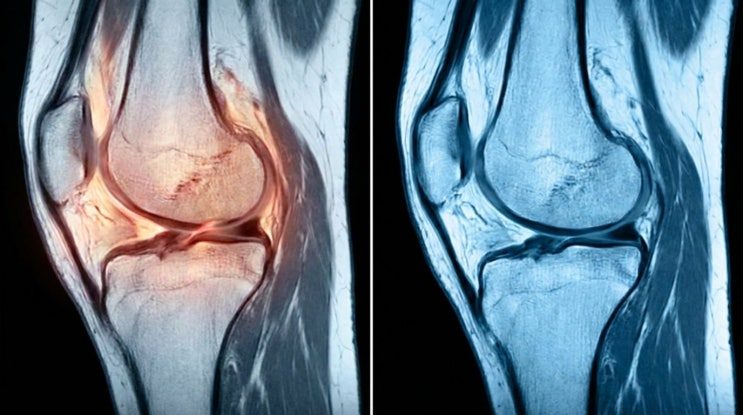 무릎 관절을 옆에서 찍은 MRI 영상 두 장, 왼쪽은 관절 부위가 주황색으로 강조되어 있고 오른쪽은 푸른 톤으로 표시된 같은 구도의 영상