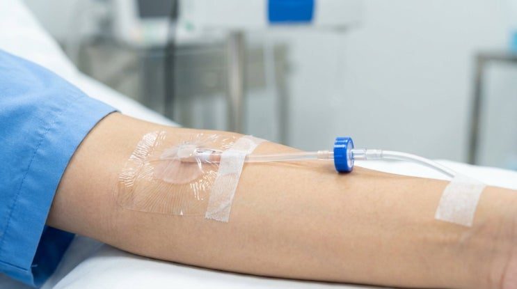 환자의 팔 정맥에 꽂힌 정맥 카테터가 투명 필름과 테이프로 고정되고 수액 줄이 연결된 모습