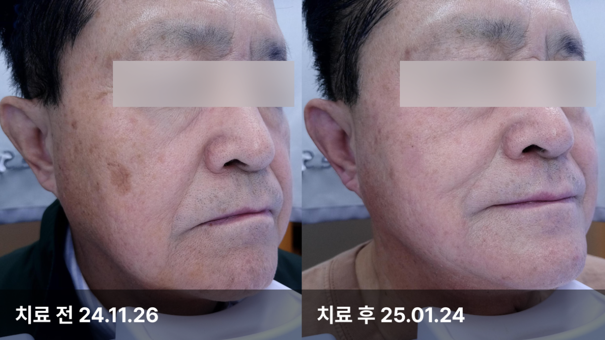 71세 남자, 피부색소치료 (토닝,CO2,532)