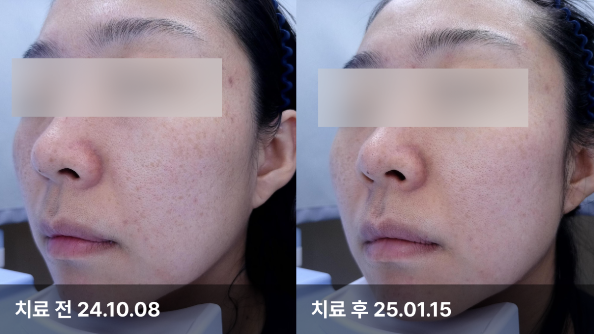 36세 여자, 피부색소,모공 치료 (토닝,실펌)