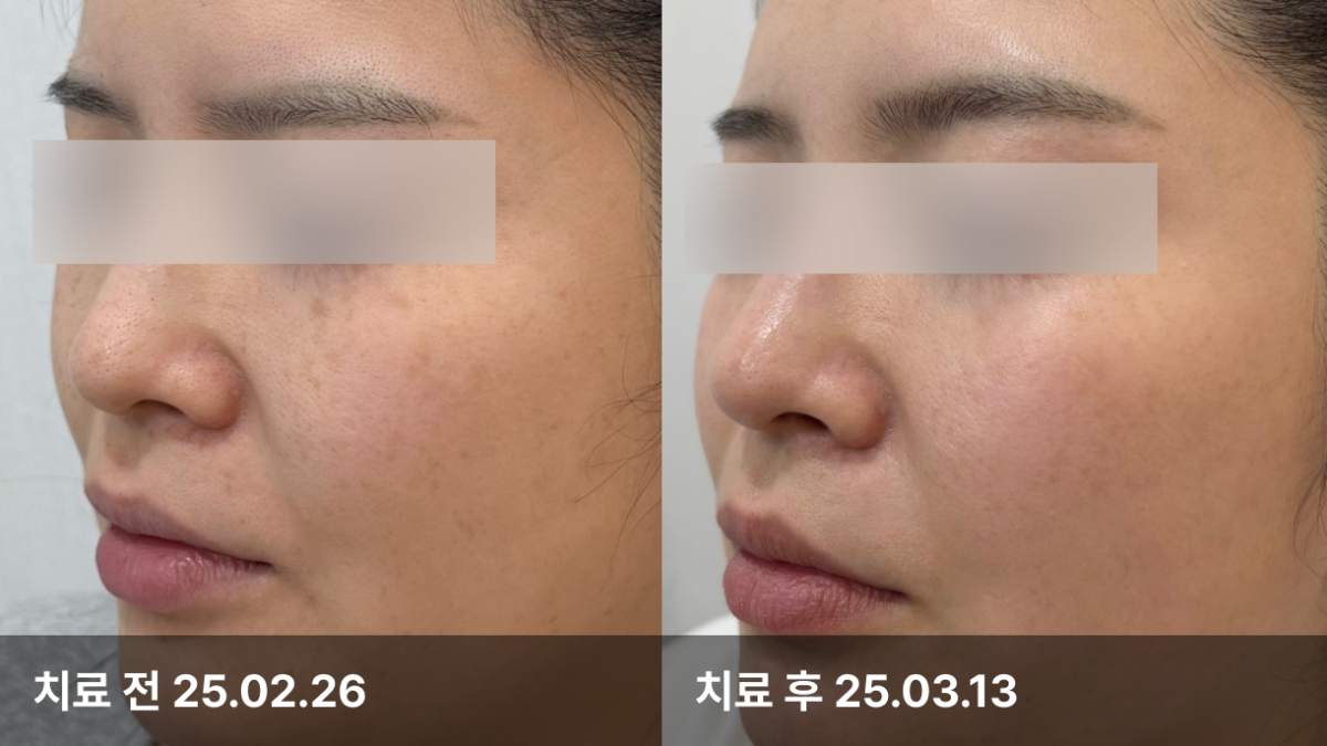 28세 여자, 피부모공치료 (리쥬베룩)