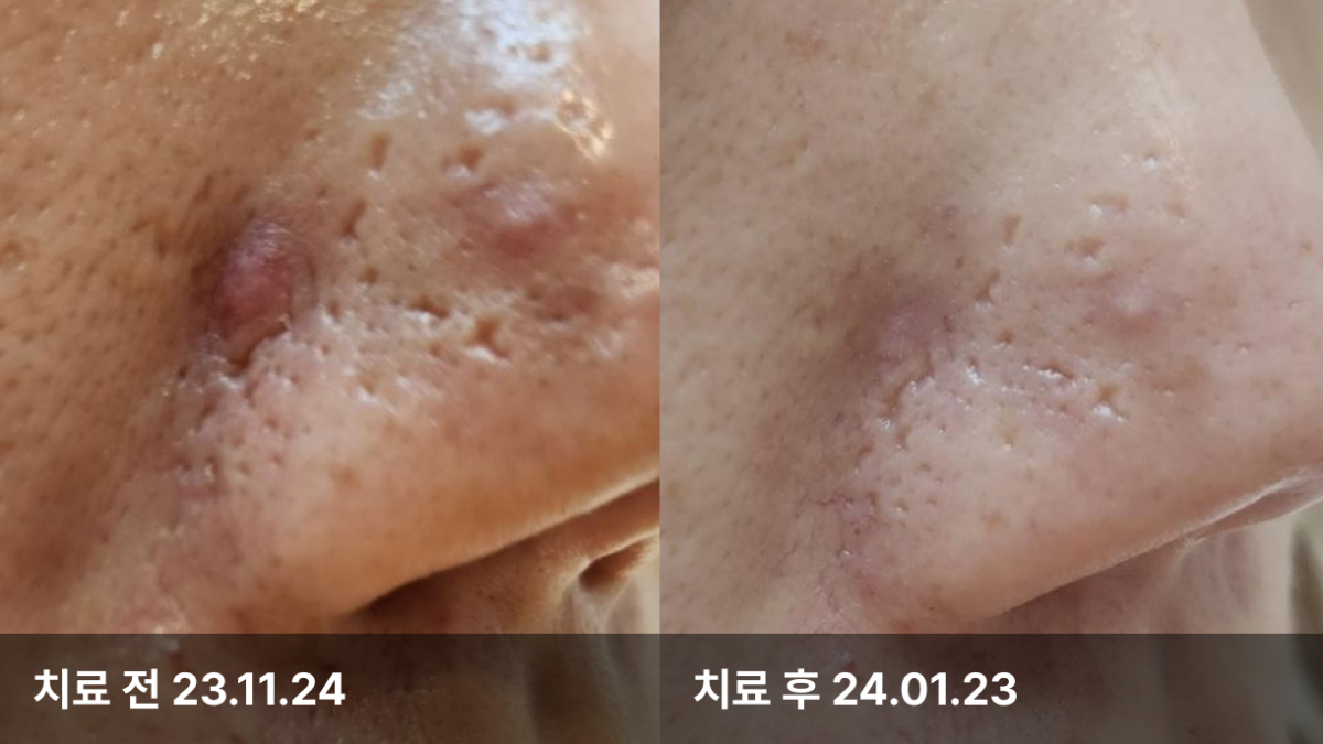 32세 여자, 피부모공치료 (쥬베룩볼륨)