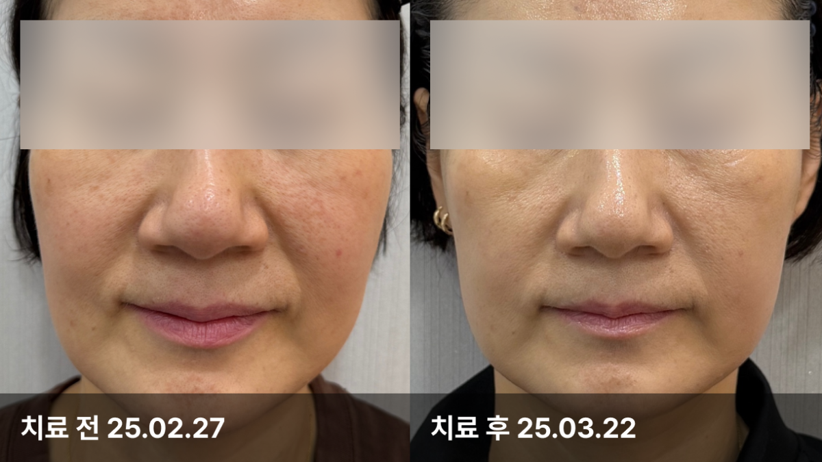 59세 여자, 피부홍조치료 (골수줄기세포)