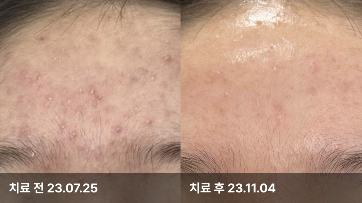 15세 여자, 피부트러블치료 (압출,프락셀,로즈필)