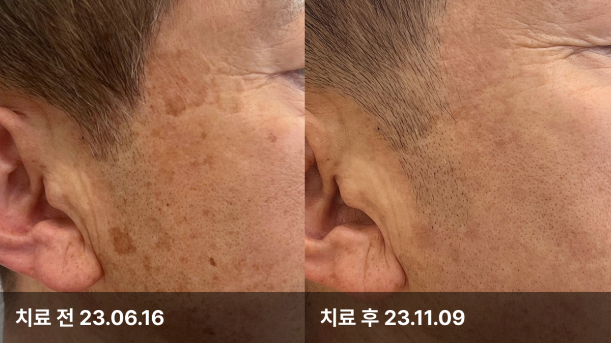 65세 남자, 피부색소치료 (IPL,CO2,532,토닝)