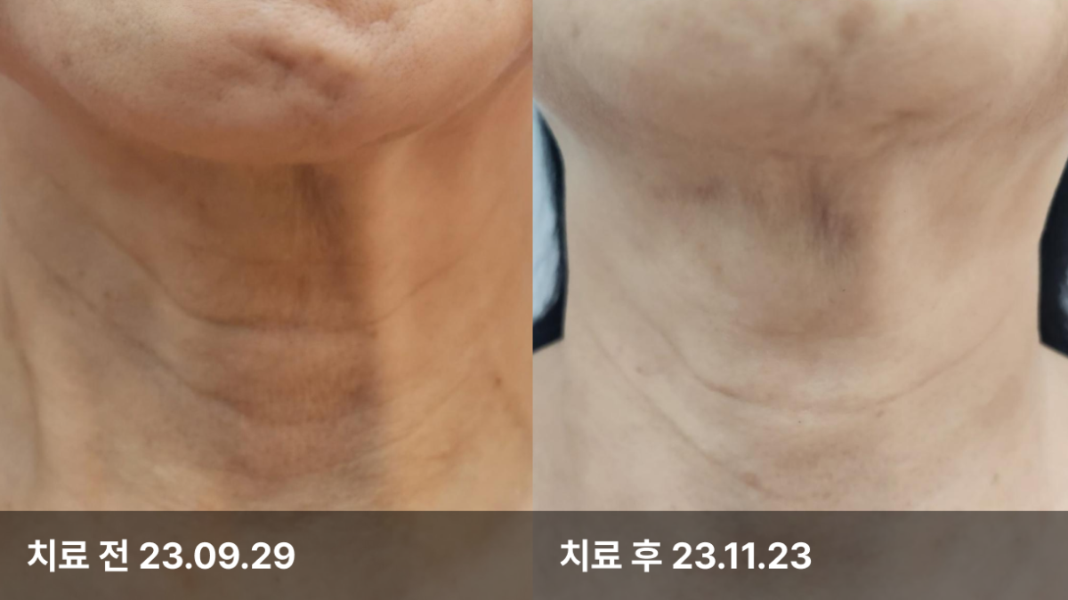 68세 여자, 목주름치료(PRP,쥬베룩볼륨)