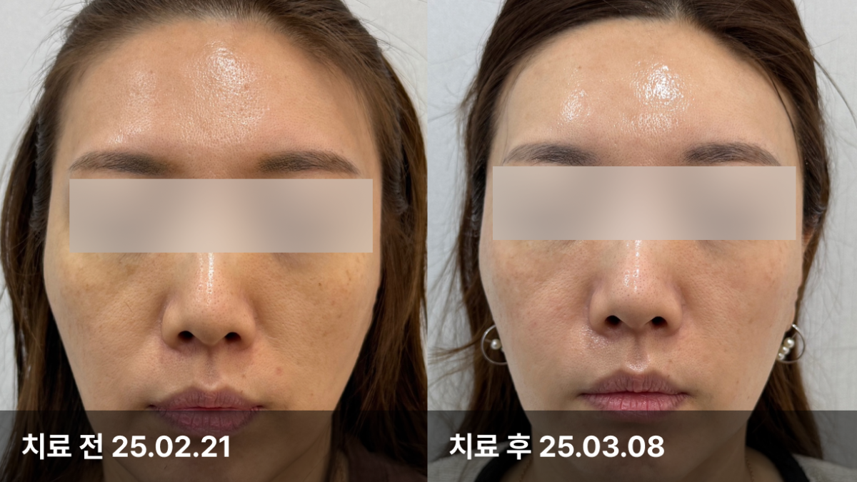 45세 여자, 피부볼륨,동안치료(지방줄기세포)