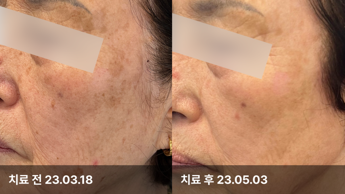 72세 여자, 피부색소치료(IPL,토닝,532)