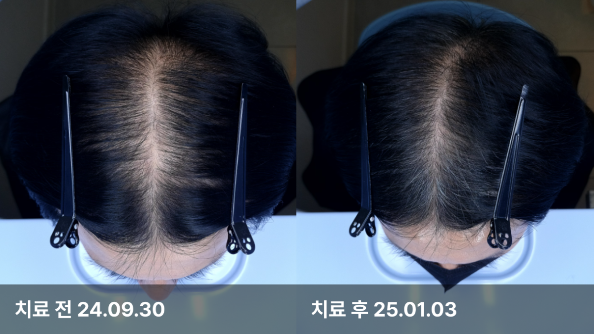 51세 남성, 유전성 탈모