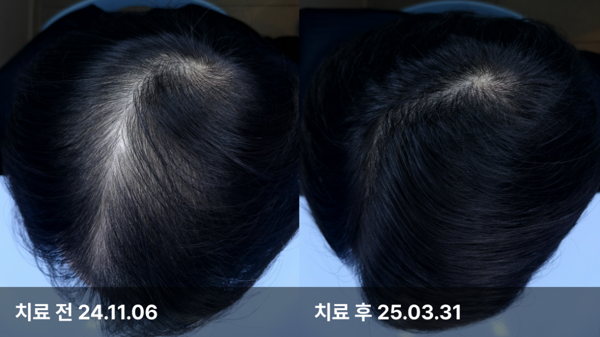 33세 남성, 유전성 탈모
