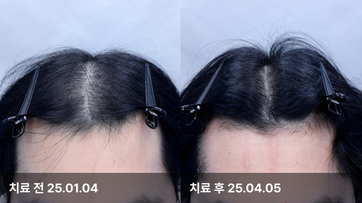 21세 남성, 유전성 탈모