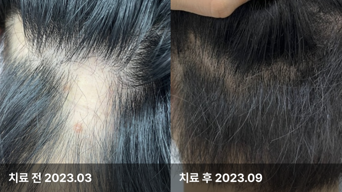 25세 남성, 원형 탈모