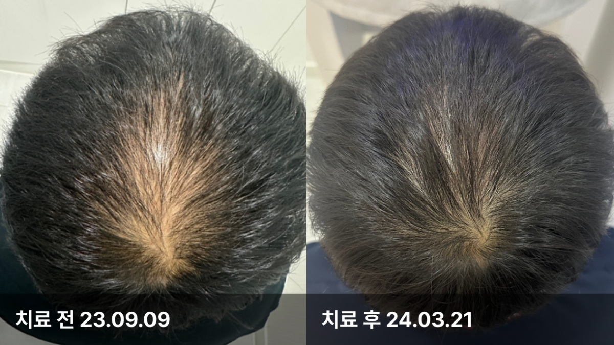 44세 남성, 유전성 탈모