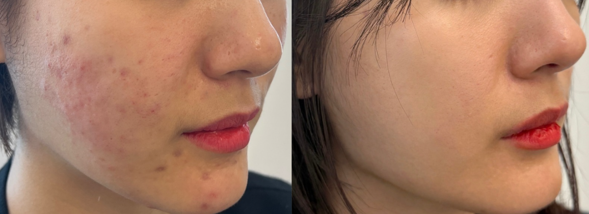 부산여드름, 흉터/모공 남기지 않고 치료했던 환자의 특징?