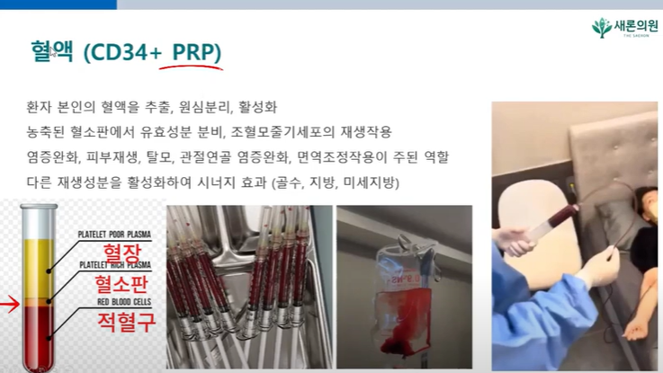 줄기세포종류? 혈액(PRP), 골수(BMAC), 지방(SVF) 줄기세포 채취방법 및 치료 효과